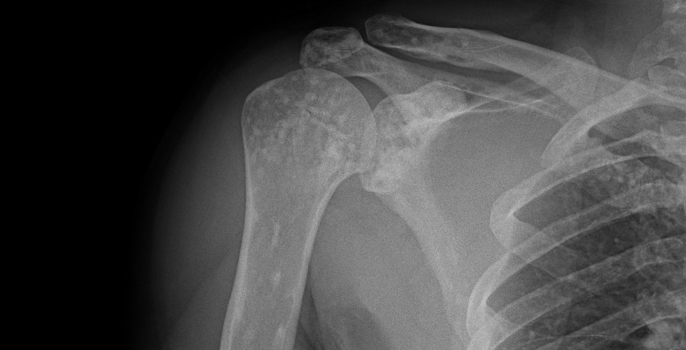 Osteopoikilosis | Image | Radiopaedia.org