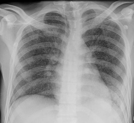 Tuberculosis (pulmonary manifestations) | Radiology Reference Article ...