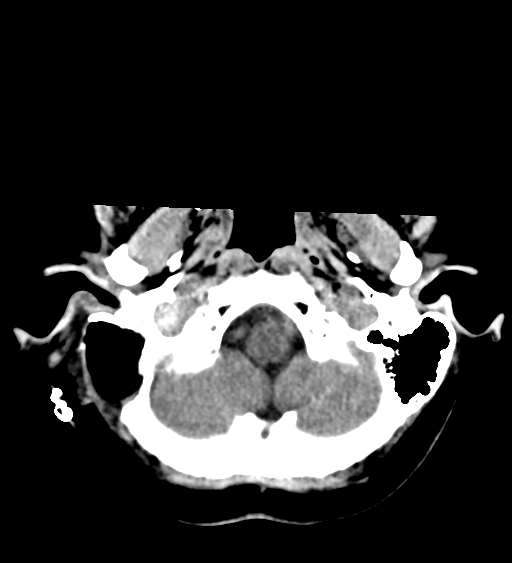 Internal Jugular Vein Thrombosis Image 4016