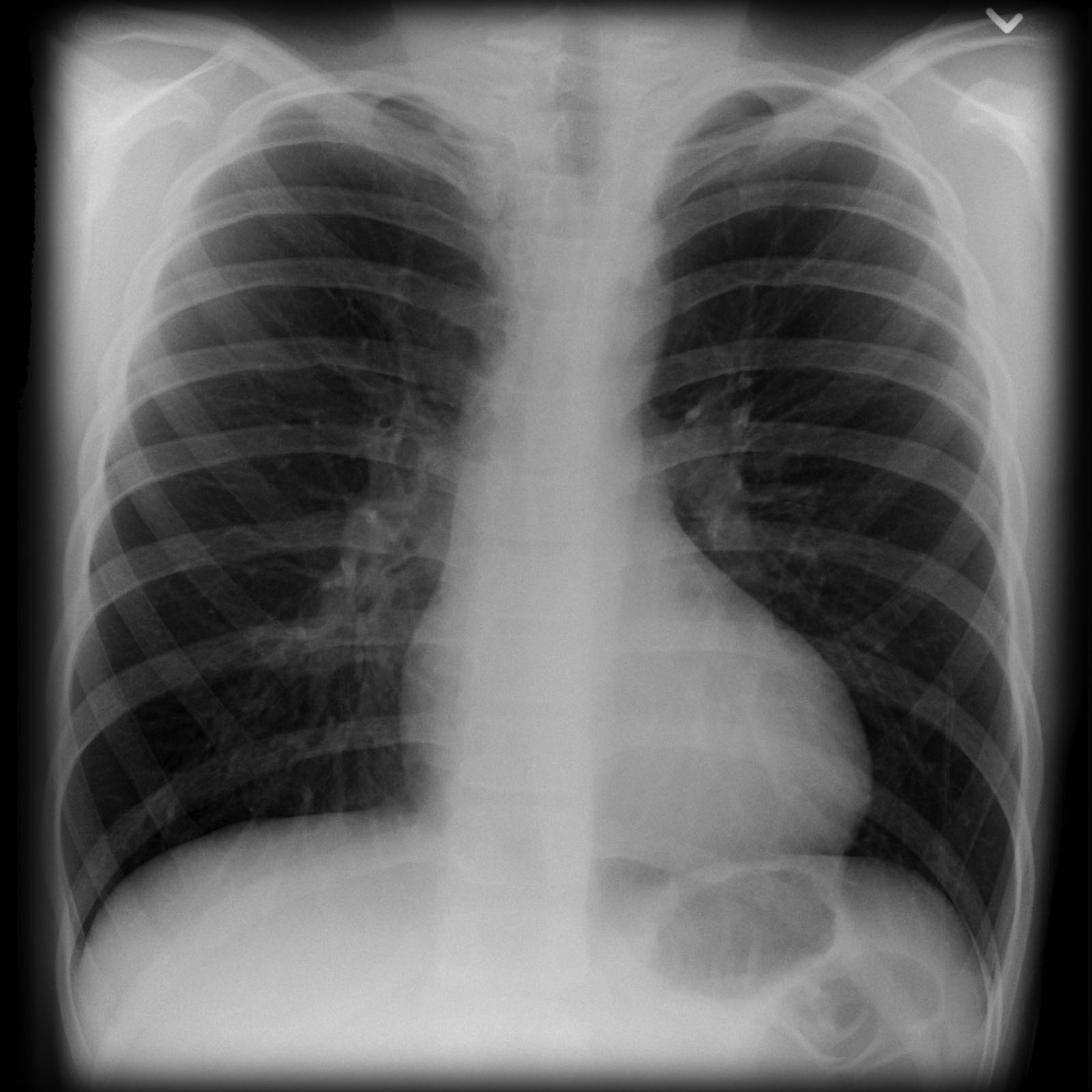 Coarctation of the aorta | Image | Radiopaedia.org