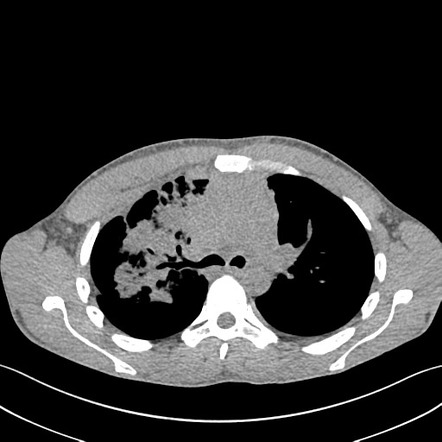 Mediastinal CT-guided biopsy (large B-cell lymphoma) | Image ...