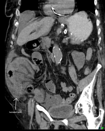 Internal hernia | Radiology Reference Article | Radiopaedia.org