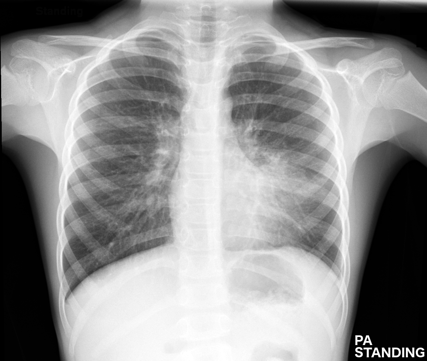 Пневмония легких. Atelectasis lung XRAY. Вирусная пневмония рентген.