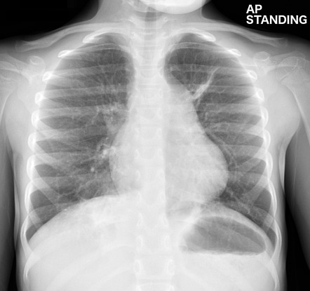 Childhood pneumonia | Image | Radiopaedia.org