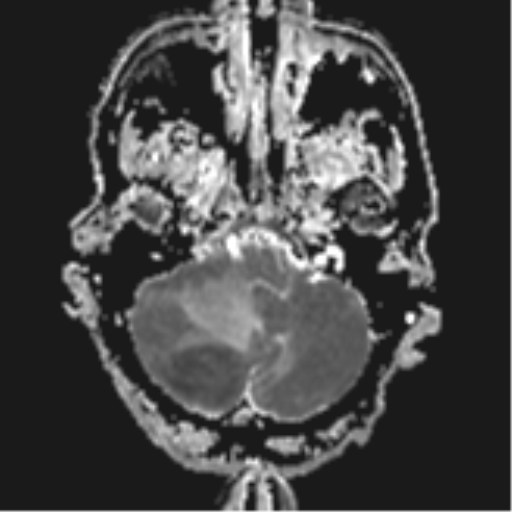 Cerebral Metastases Abscess Mimic Image Radiopaedia Org