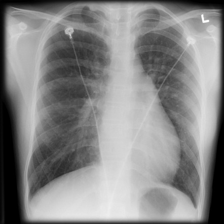 Atrial septal defect | Radiology Reference Article | Radiopaedia.org