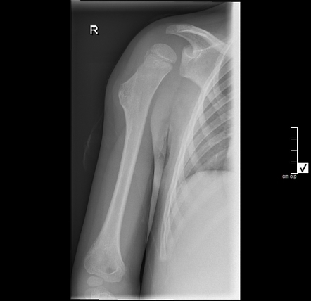 osteochondroma left humerus icd 10