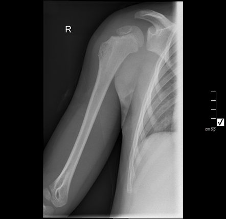 Osteochondroma - humerus | Image | Radiopaedia.org