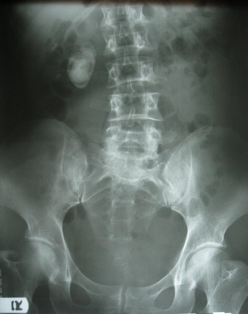 Kidney Stones Xray