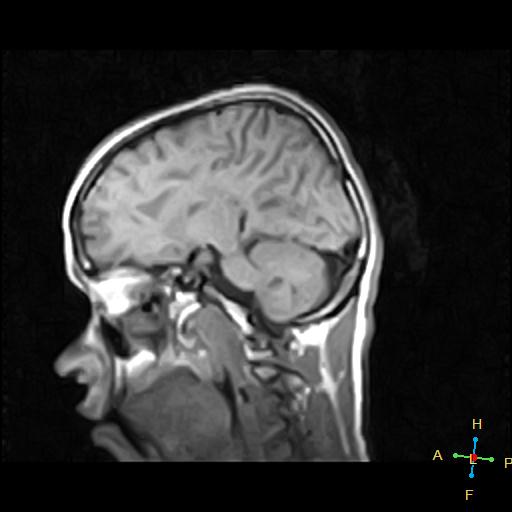 Corpus callosum agenesis | Image | Radiopaedia.org