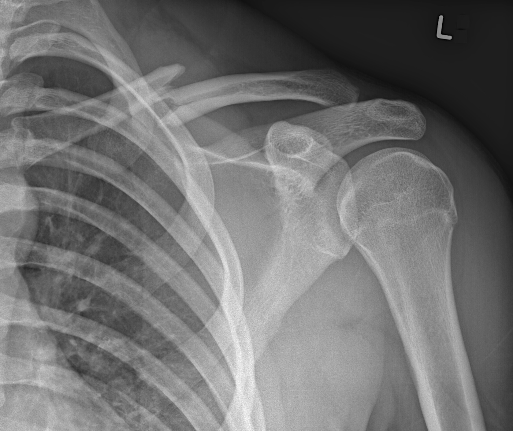 X Ray Broken Collar Bone