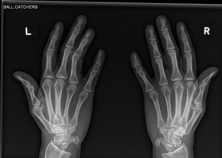 Hand (ball-catcher view) | Radiology Reference Article | Radiopaedia.org