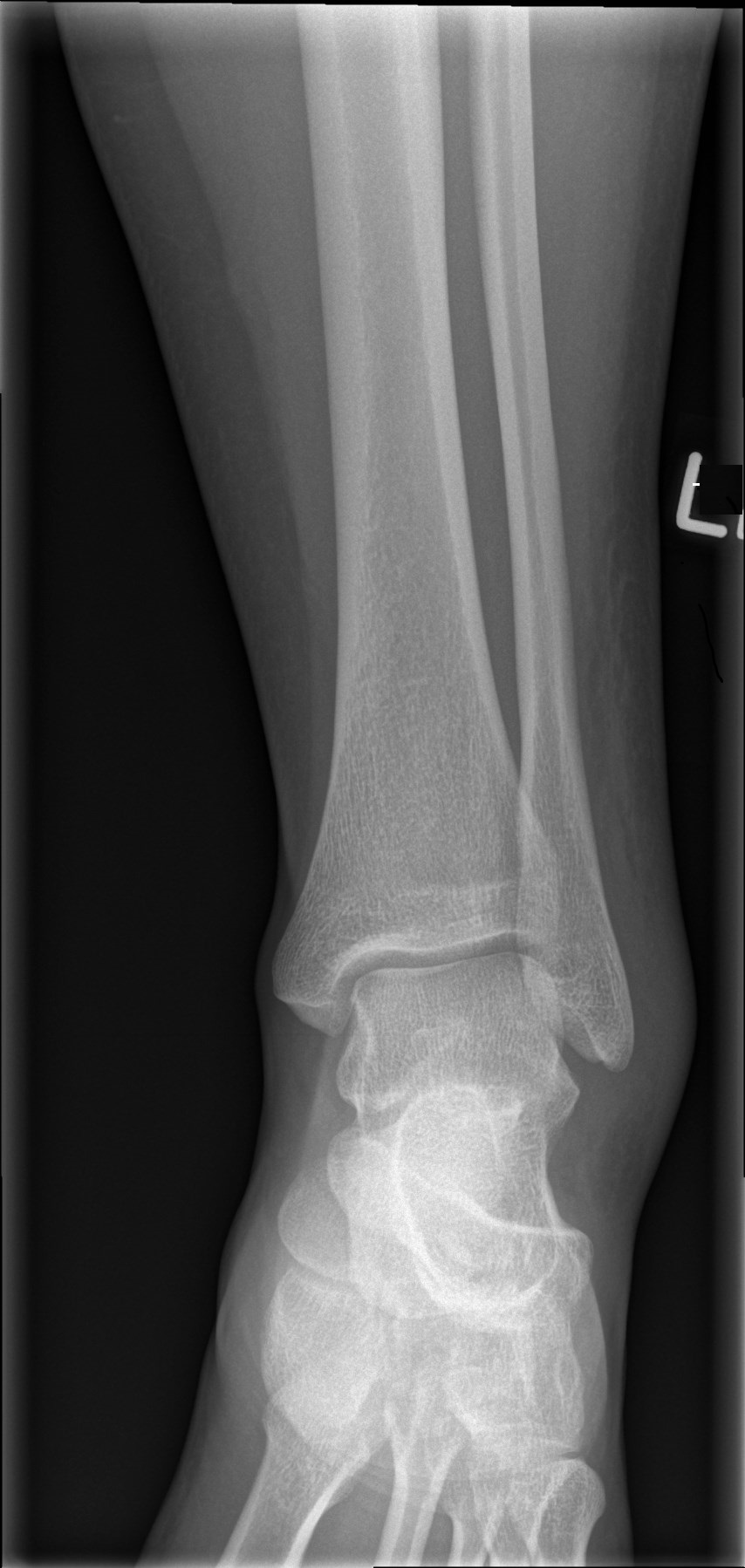 X Ray Ankle Ap