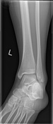 Ankle (mortise view) | Radiology Reference Article | Radiopaedia.org