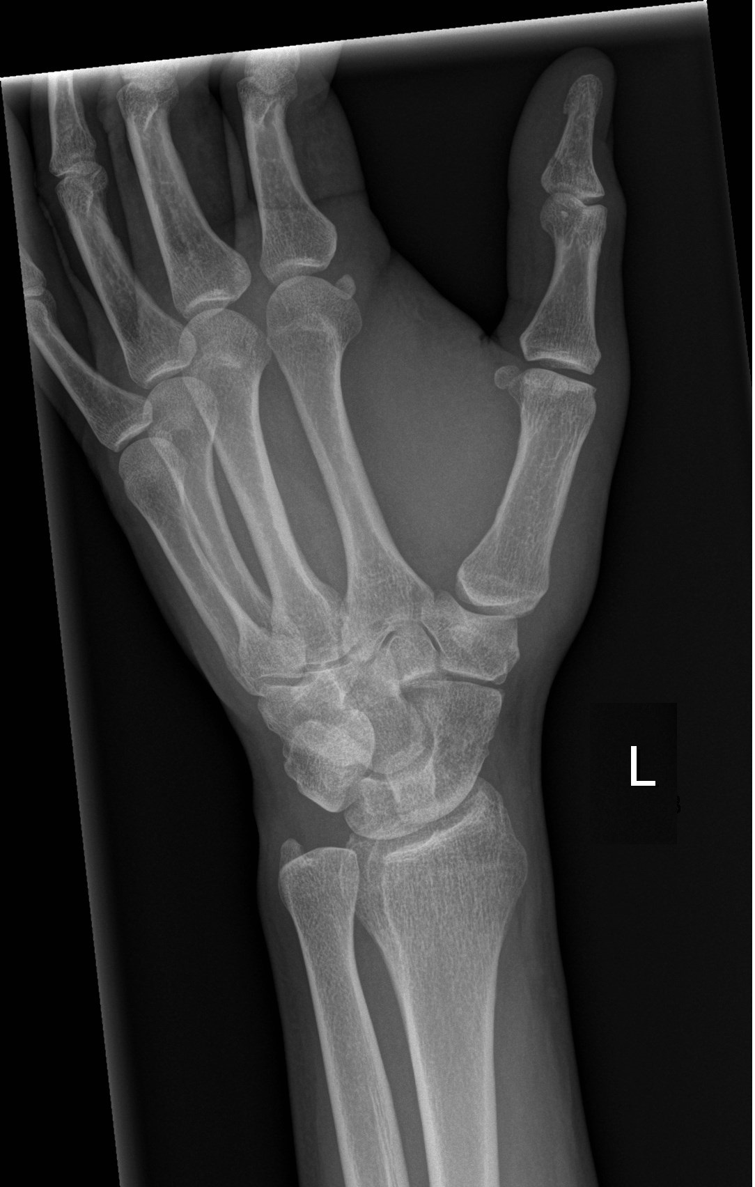 wrist xray normal