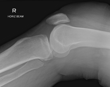 Knee (horizontal beam lateral view) | Radiology Reference Article ...