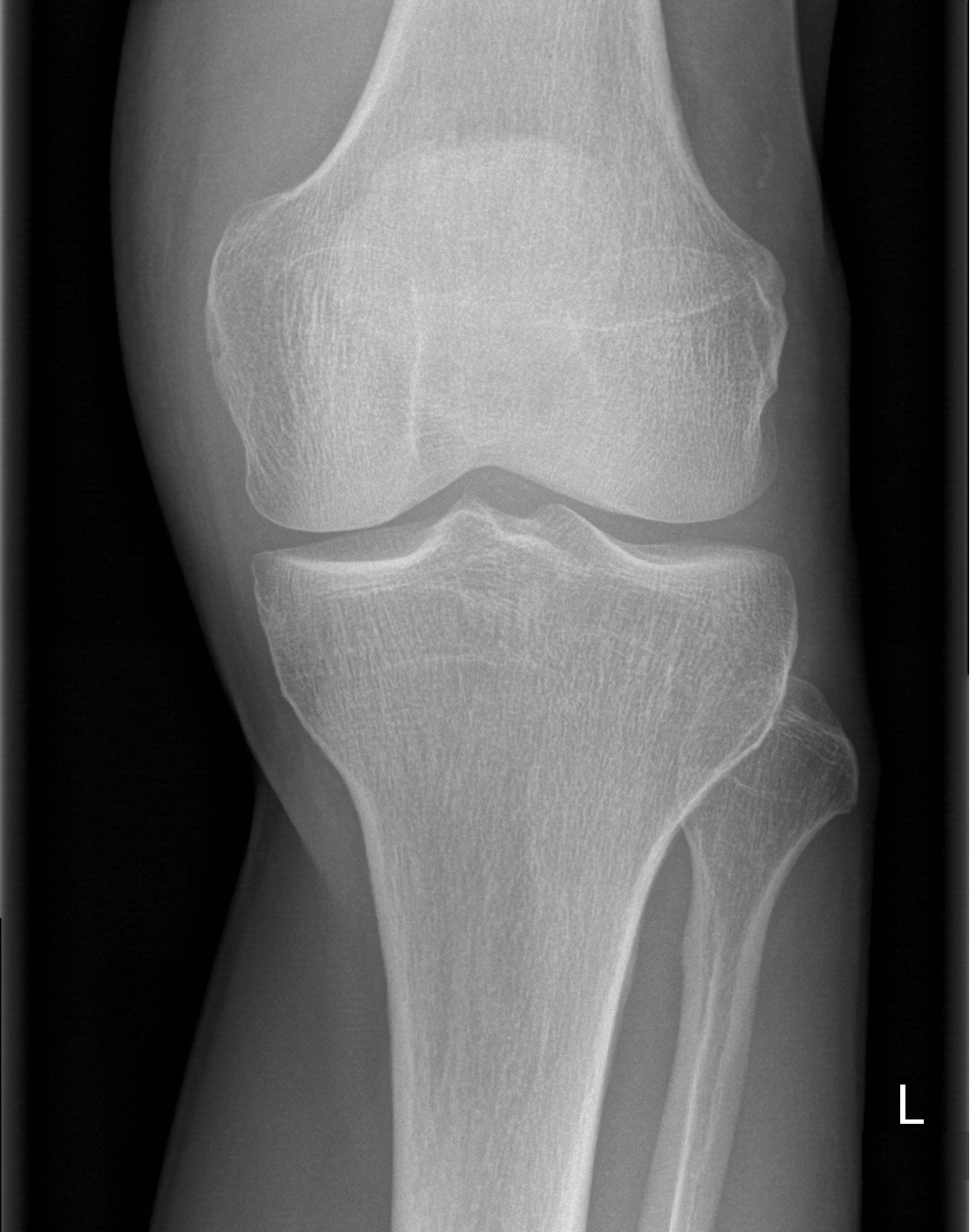 Normal knee | Image | Radiopaedia.org