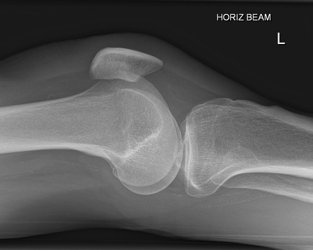 Fat pad separation sign (knee joint effusion) | Radiology Reference ...