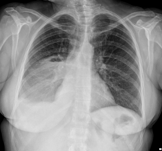 Cavitating lung mass - squamous cell carcinoma | Image | Radiopaedia.org