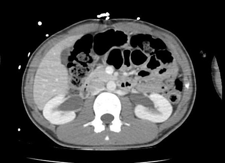 Scoth Control Abdomen