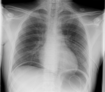 Post splenectomy chest radiograph | Radiology Case | Radiopaedia.org