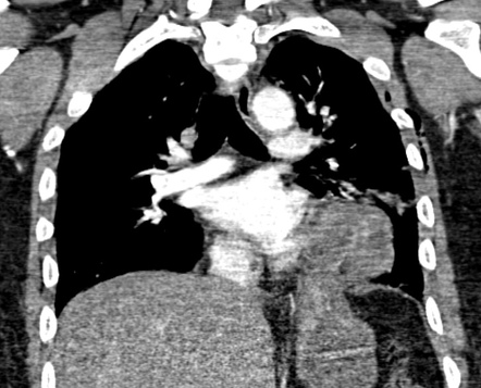 Diaphragmatic rupture | Radiology Reference Article | Radiopaedia.org