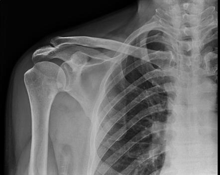 Subscapularis calcific tendinosis | Radiology Case | Radiopaedia.org