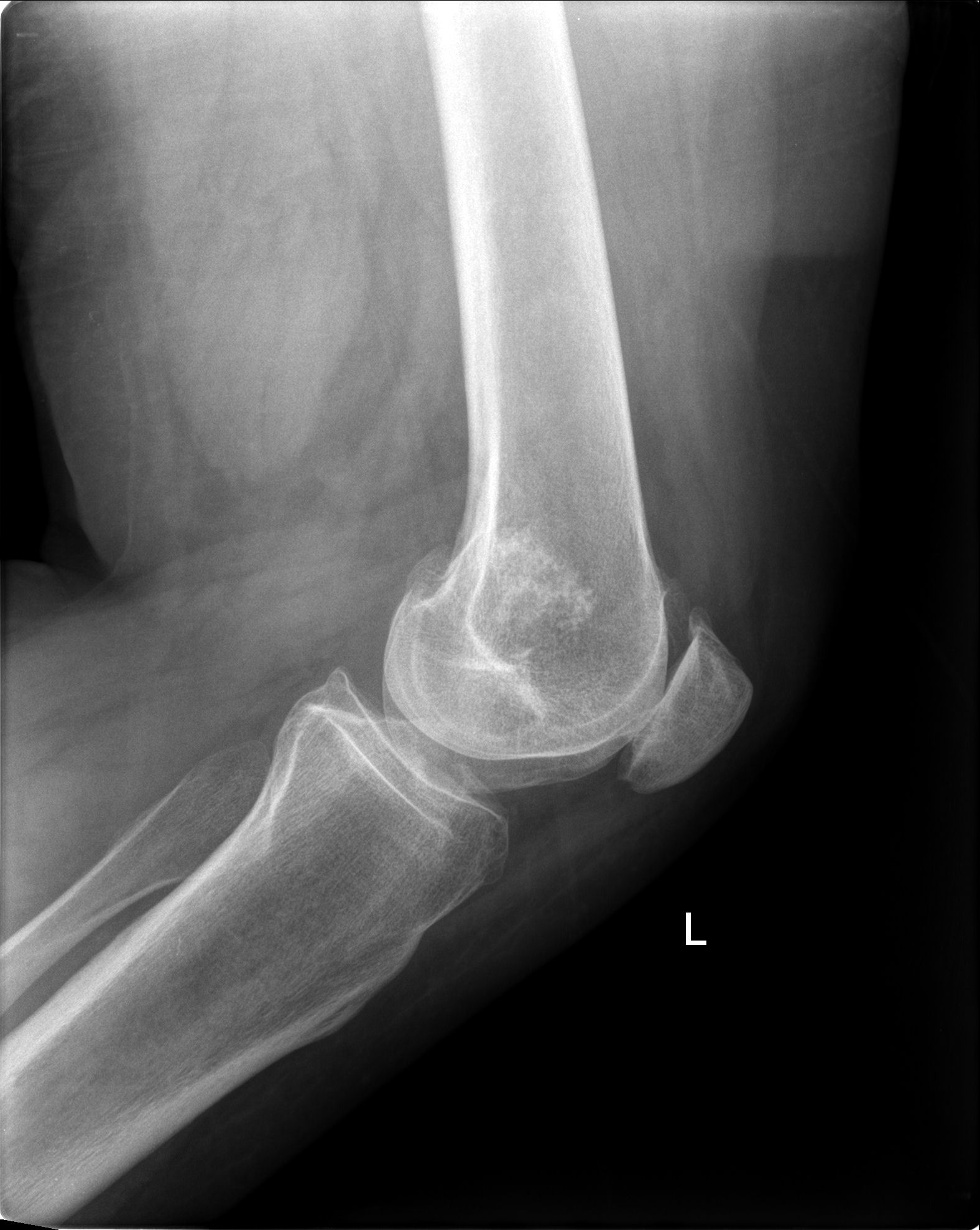 Enchondroma - knee | Image | Radiopaedia.org