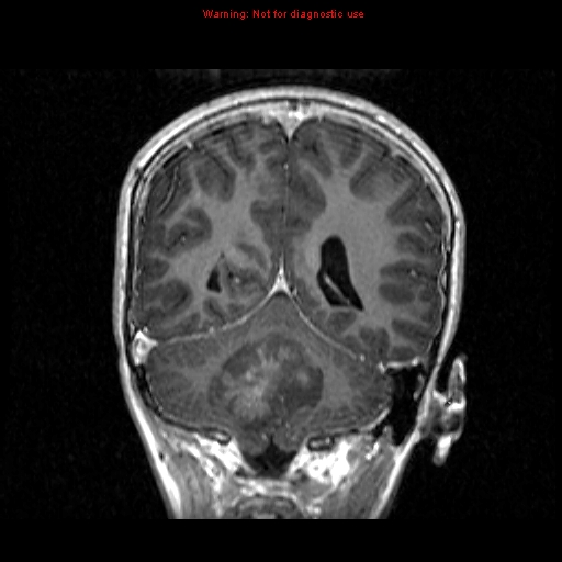 Medulloblastoma | Image | Radiopaedia.org