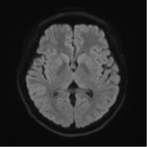 Cerebral cavernous venous malformations | Image | Radiopaedia.org