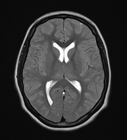 Global hypoxic injury | Image | Radiopaedia.org