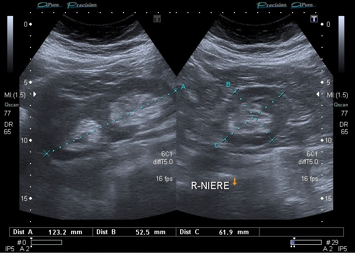 Узи полное. Неполное удвоение почки на УЗИ. Удвоение почки на УЗИ. Удвоенная почка на УЗИ. Полное удвоение почки на УЗИ.