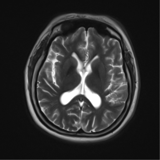 Lennox-Gastaut syndrome | Image | Radiopaedia.org