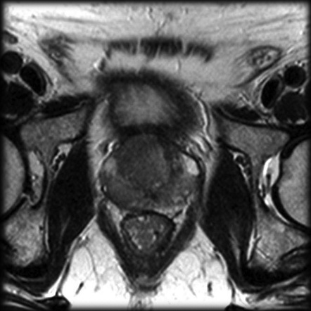 prostate carcinoma staging radiopaedia)