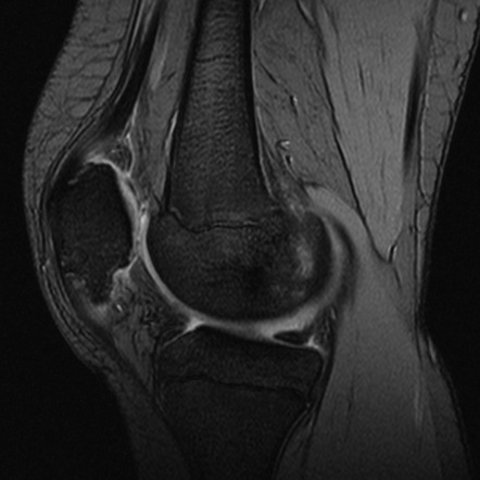 Sinding-Larsen-Johansson disease | Radiology Reference Article