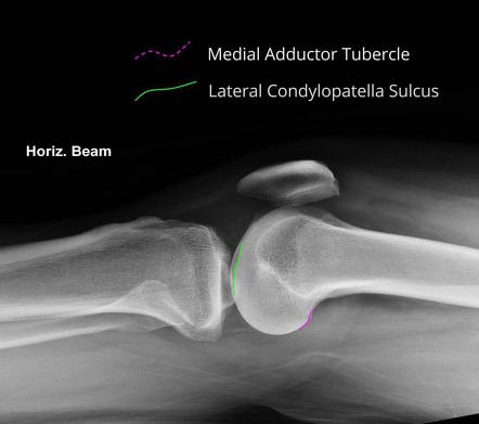 Knee (lateral view) | Radiology Reference Article | Radiopaedia.org