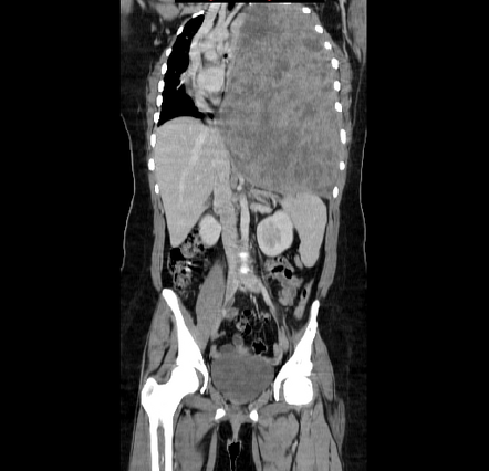 Pleural tumors | Radiology Reference Article | Radiopaedia.org