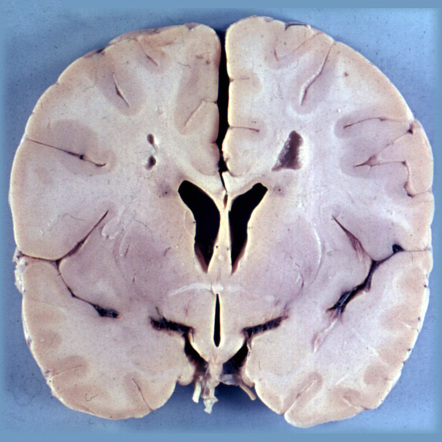 Playlist 'Leukodystrophies' by Dr M Sanal Kumar