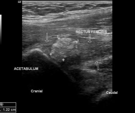 Calcific tendinitis of rectus femoris | Radiology Case | Radiopaedia.org