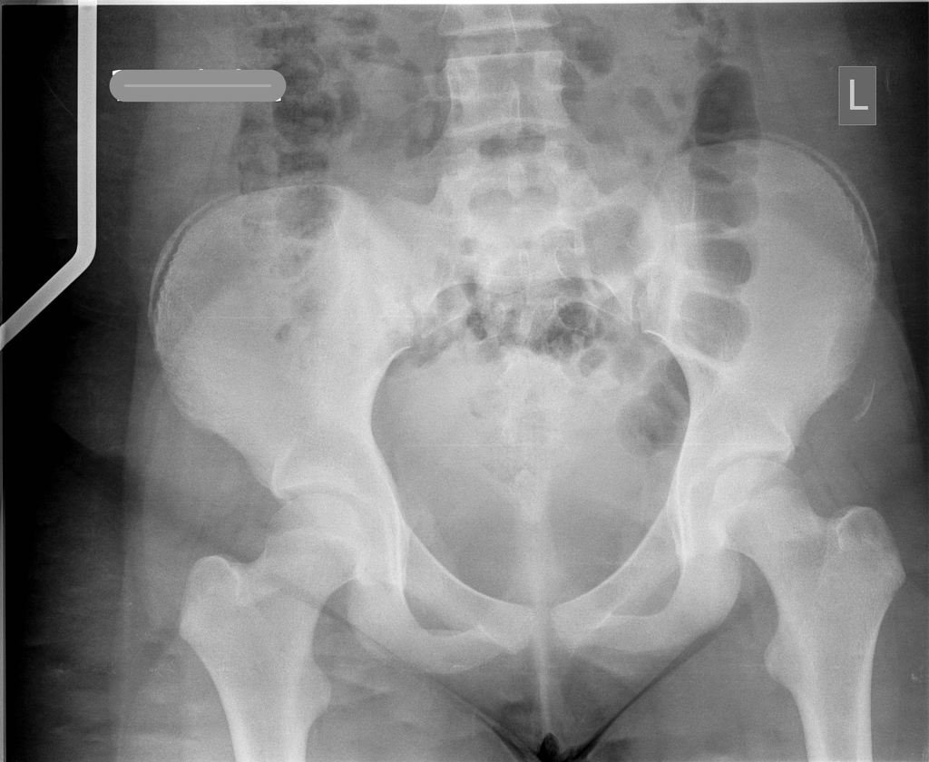 anterior superior iliac spine