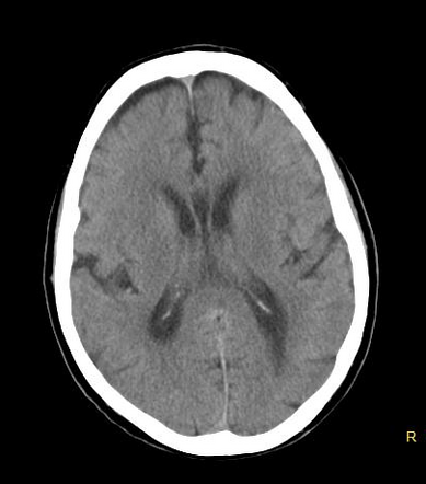 Cavum septum pellucidum | Radiology Case | Radiopaedia.org