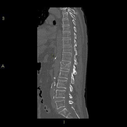 Burst fracture | Radiology Reference Article | Radiopaedia.org