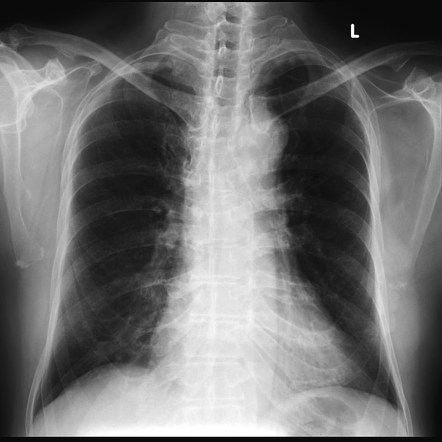 Coracoclavicular joint | Radiology Case | Radiopaedia.org