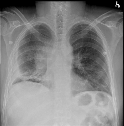 Tuberculous discitis, osteomyelitis and paravertebral abscess ...