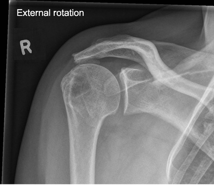 Subacromial Impingement | Image | Radiopaedia.org