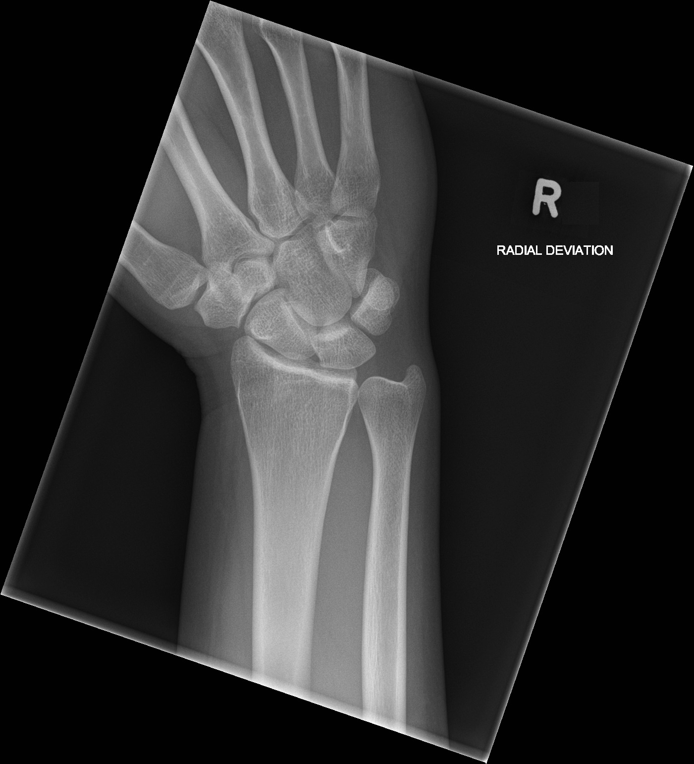 Normal Wrist Image