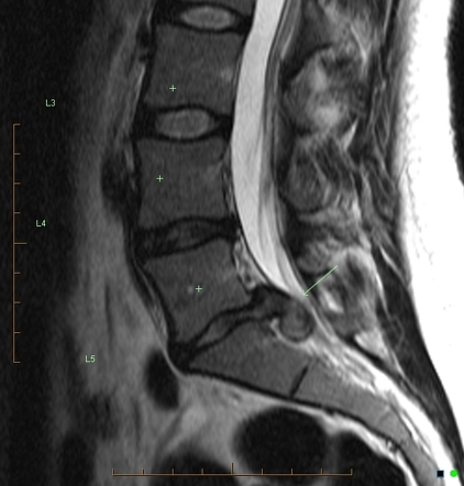 Viewing playlist: MRI Spine | Radiopaedia.org