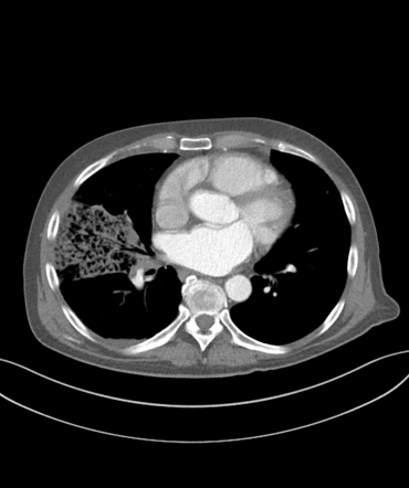 Pulmonary infarction | Image | Radiopaedia.org