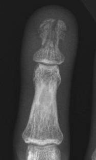 Phalangeal tuft fracture | Image | Radiopaedia.org