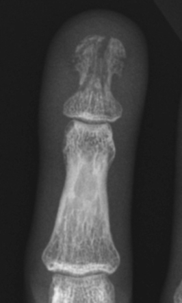 Phalangeal tuft fracture | Radiology Case | Radiopaedia.org